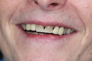 Denise before treatment