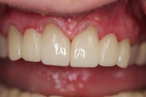 Closeup of Denise's teeth