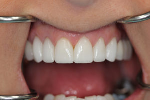 Closeup of Mardi's teeth