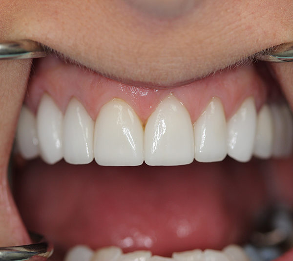 Closeup of Mardi's teeth