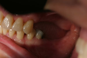 Closeup of Pam's teeth