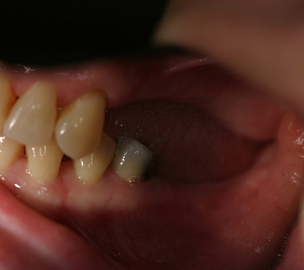 Closeup of Pam's teeth