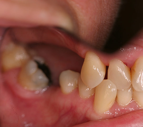 Closeup of Pam's teeth