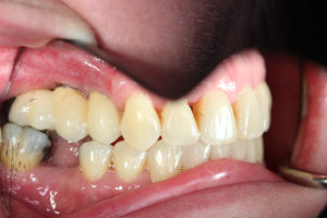 Closeup of Pam's teeth