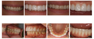 Closeups of teeth before and after treatment