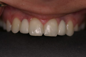 Kate After Dental Implants