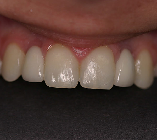 Kate After Dental Implants