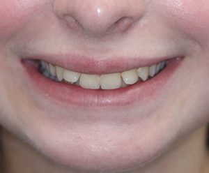 Teeth before treatment