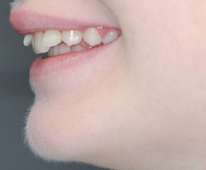 Teeth before treatment