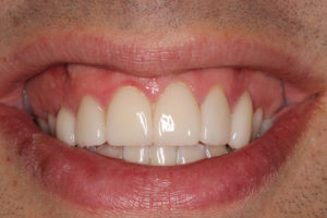 Bradley's teeth after clearalign