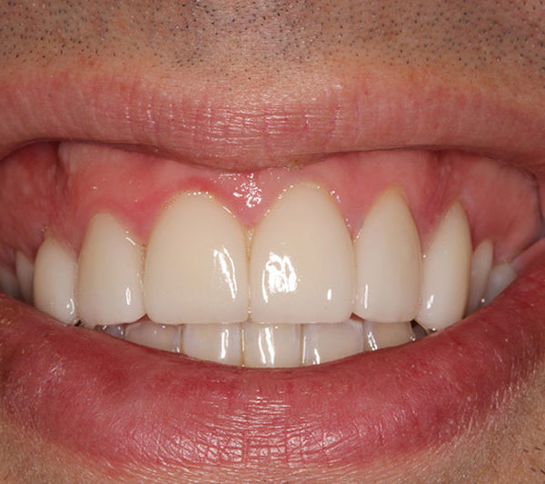 Bradley's teeth after clearalign