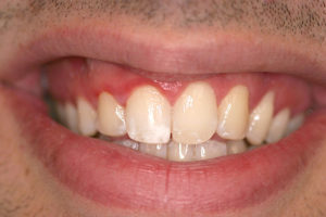 Bradley's teeth before treatment