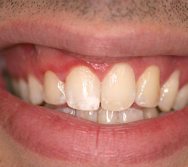 Bradley's teeth before treatment
