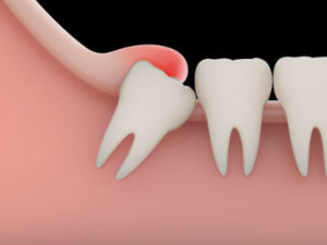 Graphic of an impacted tooth