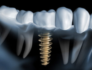 Graphic of a dental implant