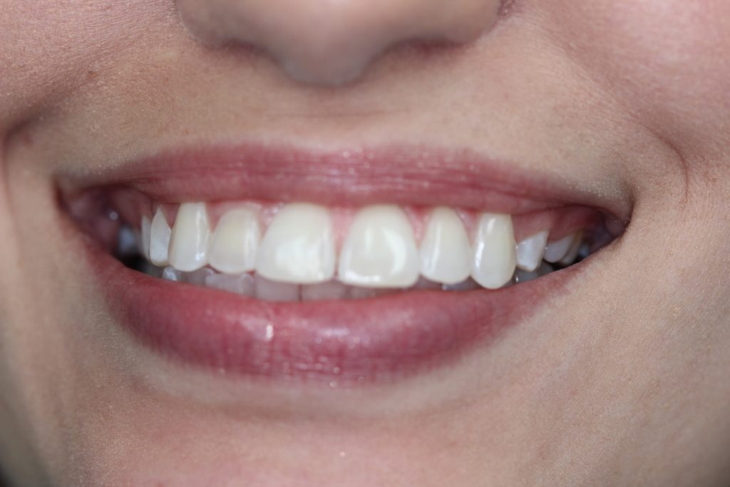 Closeup of Melinda Hill's teeth