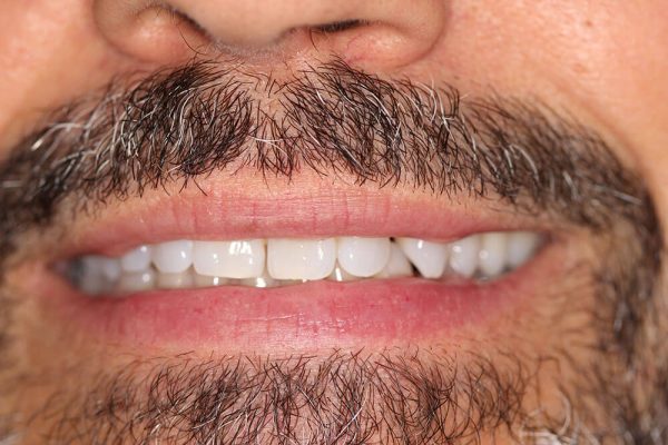 Closeup of a man's teeth