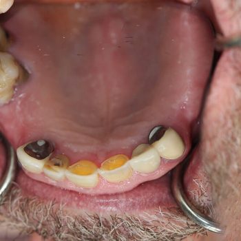 Closeup of missing teeth