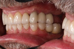 Closeup of Louis' teeth after treatment