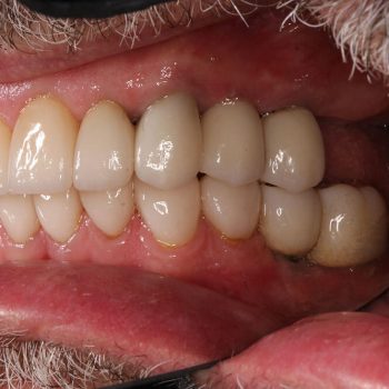 Closeup of Louis' teeth after treatment