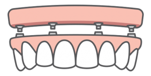 Graphic of a full-arch replacement