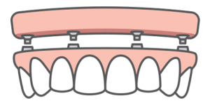 Graphic of a full-arch replacement