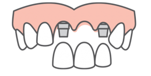 Graphic of multiple dental implants