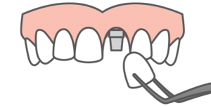 Graphic of a dental implant