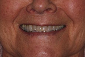 Closeup of Beverly's teeth