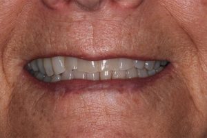 Closeup of Beverly's teeth