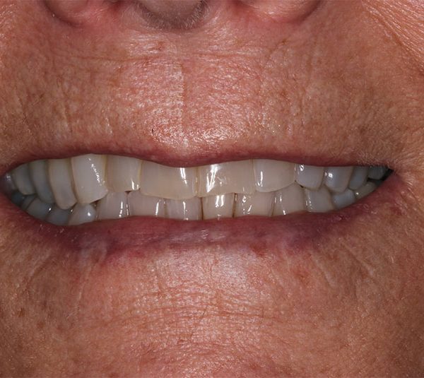 Closeup of Beverly's teeth