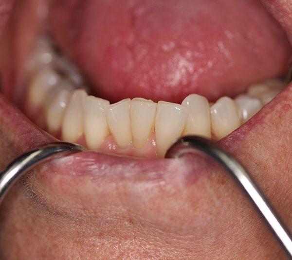 Closeup of Beverly's teeth