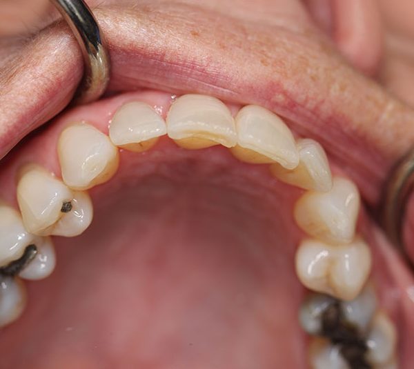 Closeup of Beverly's teeth