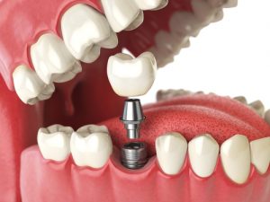 dental implant model