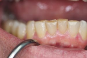 Closeup of Mike's teeth