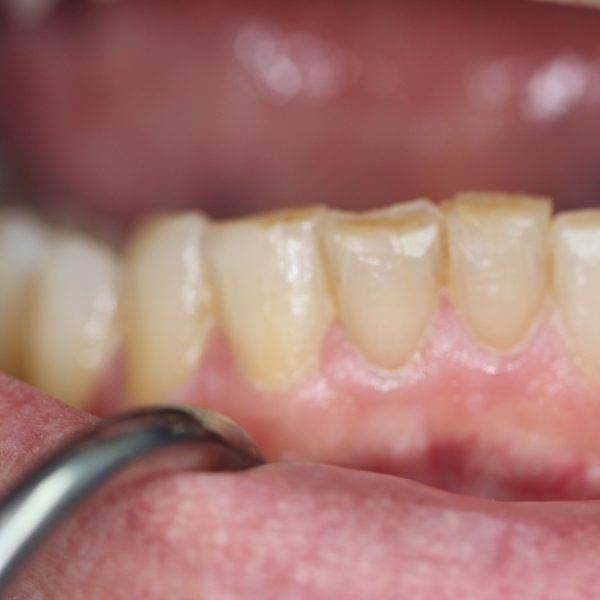 Closeup of Mike's teeth