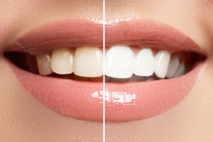 close-up of smile before and after teeth whitening