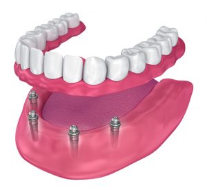 model of implant-supported dentures