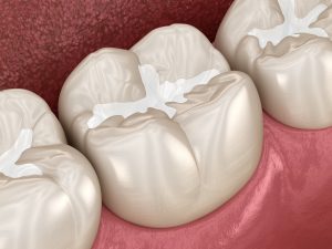 Dental filling in fillings, sealants, and crowns