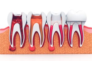 stages of root canal therapy in Greensburg, PA