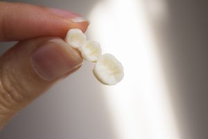 A model of a dental bridge