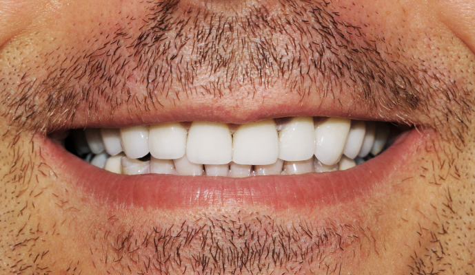 Perfectly restored teeth